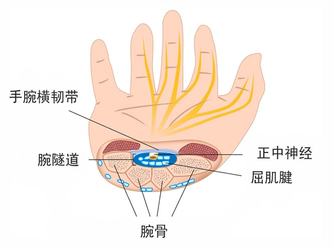 腕隧道,增生疗法精准治疗