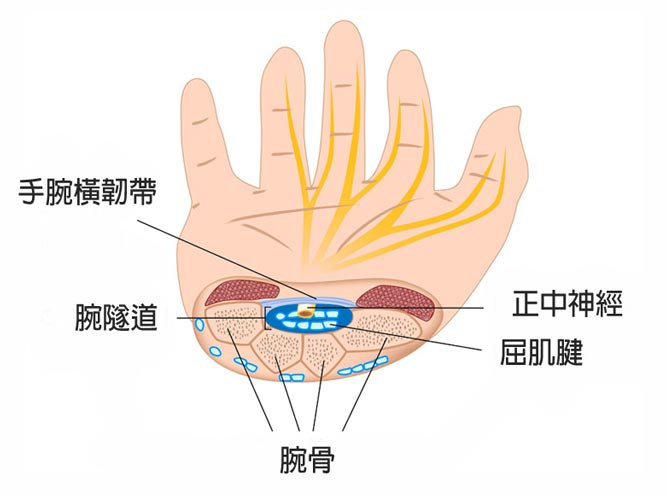 神經痛, 手麻, PRP, 神經壓迫, 腕隧道症候群, 增生療法, 台北推薦診所, 菁英診所, 復健科, 手痛