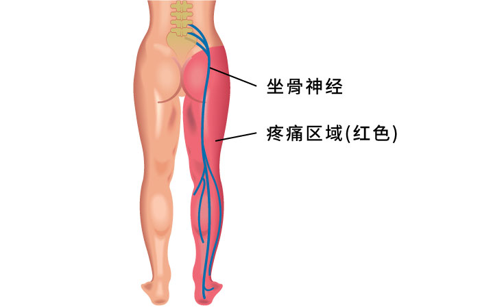 脚痛、脚麻、椎间盘突出、坐骨神经痛、PRP，增生疗法，菁英诊所，台北推荐的诊所