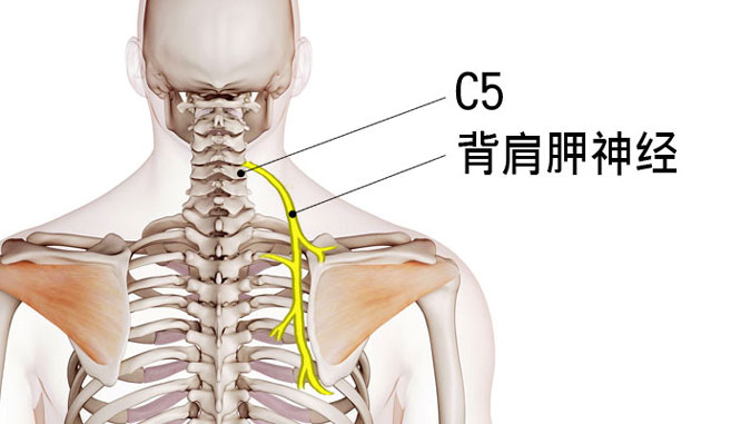 背肩胛神经,上背疼痛主因