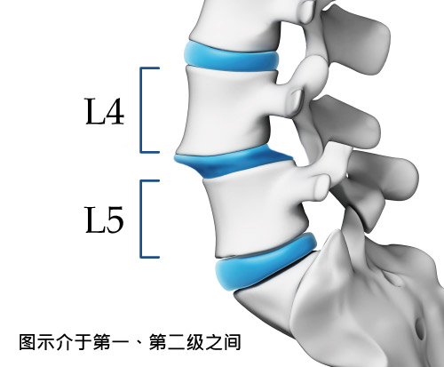 脊椎滑脱