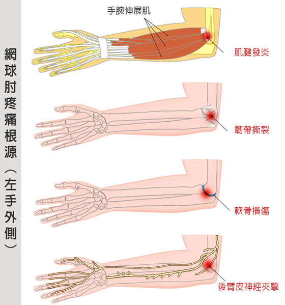 PRP、肌腱炎、網球肘、手肘痛, 增生療法治療網球肘，網球肘疼痛根源：手肘肌腱發炎、手肘韌帶撕裂、手肘軟骨損傷、手肘後臂皮神經夾擊