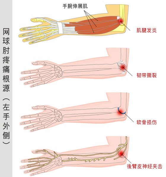 网球肘疼痛根源：手肘肌腱发炎、手肘韧带撕裂、手肘软骨损伤、手肘后臂皮神经夹击