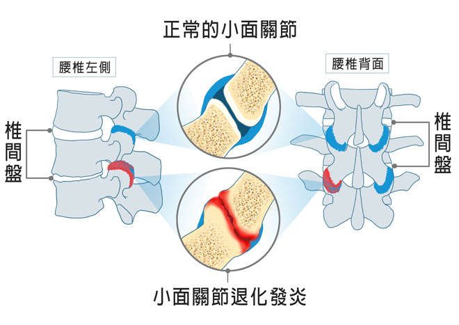 腰痛、背痛、關節炎、prp、退化性關節炎, 腰椎小面關節, 增生療法治療關節退化, 增生療法治療背痛, 台北內湖菁英診所, PRP注射治療腰痛