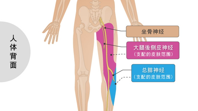 大腿后侧皮神经炎与总腓神经炎若合并发生，症状非常类似坐骨神经痛