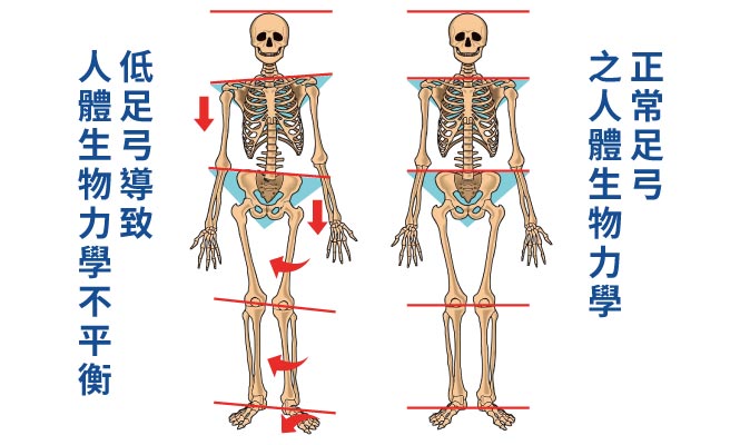 姿勢, 酸痛, 關節炎, PRP, 足弓, 足弓高低影響人體力學的平衡, 扁平足、高弓足引起腰酸背痛、膝關節退化, 台北內湖菁英診所, 推薦的復健科診所