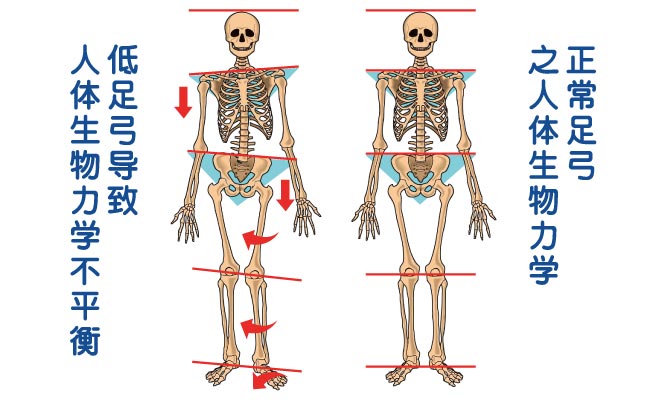 足弓高低影响人体力学的平衡