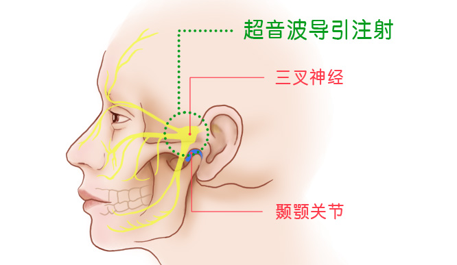 颞颚关节的关节以及三叉神经解剖图,以及超音波导引PRP注射的位置
