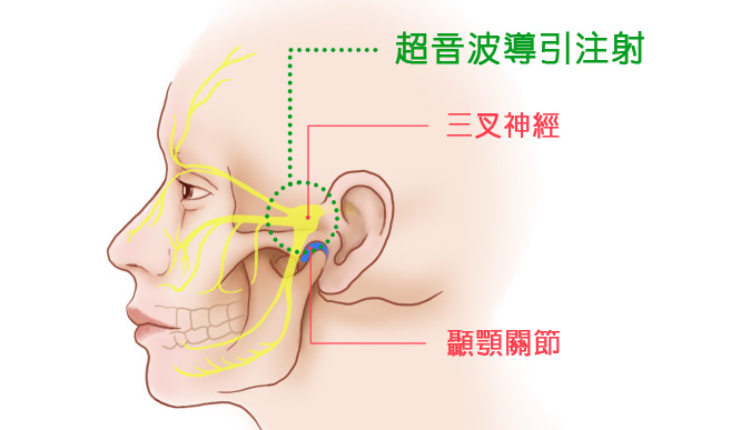 PRP, 顳顎關節, 嘴巴痛, 顳顎關節障礙, 顳顎關節的關節以及三叉神經解剖圖,以及超音波導引PRP注射的位置