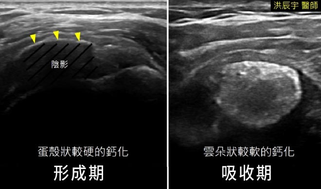 不同時期的鈣化型態,肌腱鈣化原因,肩部鈣化性肌腱炎,肩關節鈣化性肌腱炎,棘上肌肌腱鈣化