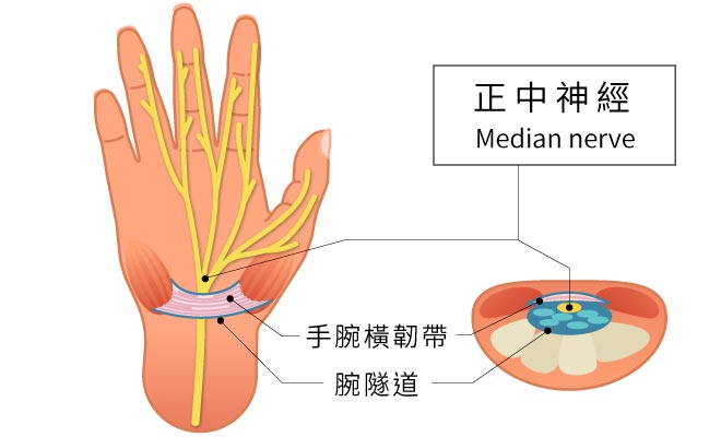 腕隧道症候群,正中神經,神經影響疼痛範圍