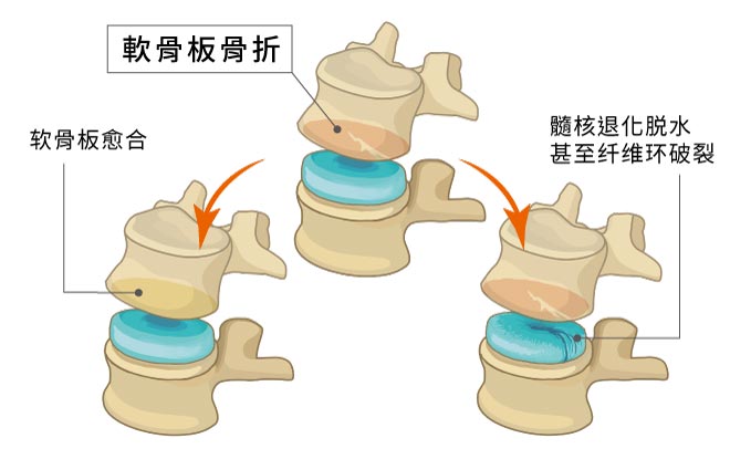 椎间盘损伤退化