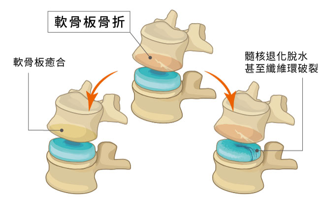 椎間盤損傷退化