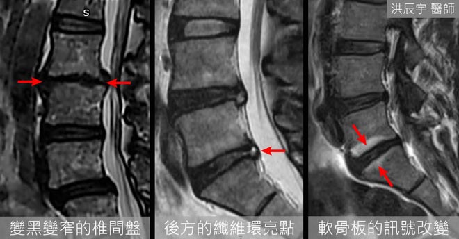 椎間盤核磁共振診斷損傷狀況