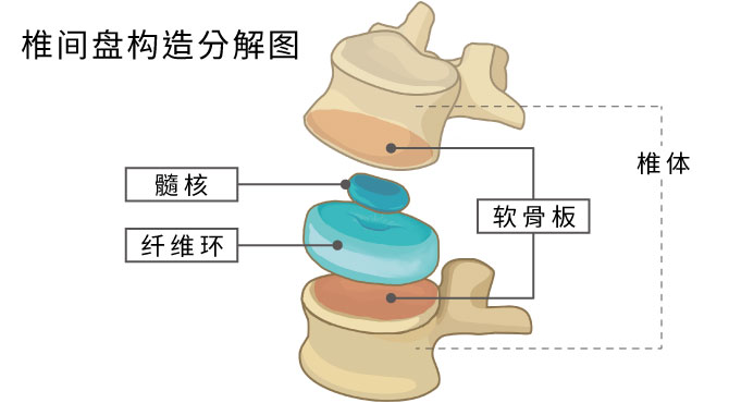 椎间盘构造分解图,椎间盘包括三个部份是髓核、纤维环、软骨板
