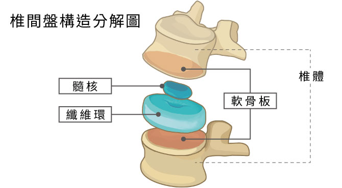 椎間盤構造分解圖，椎間盤包括三個部份是髓核、纖維環、軟骨板