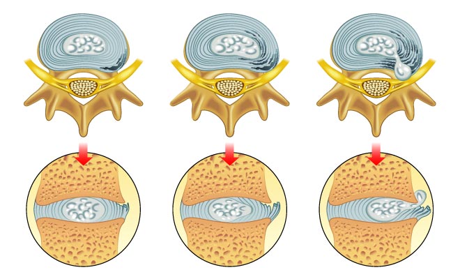 從椎間盤纖維環撕裂傷發展至椎間盤突出之病程