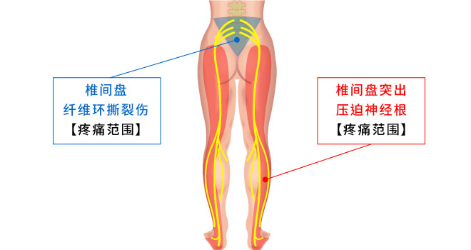 椎间盘纤维环撕裂伤及椎间盘突出压迫神经根之疼痛范围