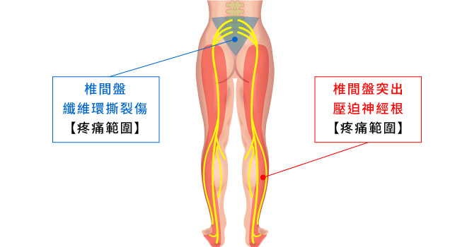 椎間盤纖維環撕裂傷及椎間盤突出壓迫神經根之疼痛範圍