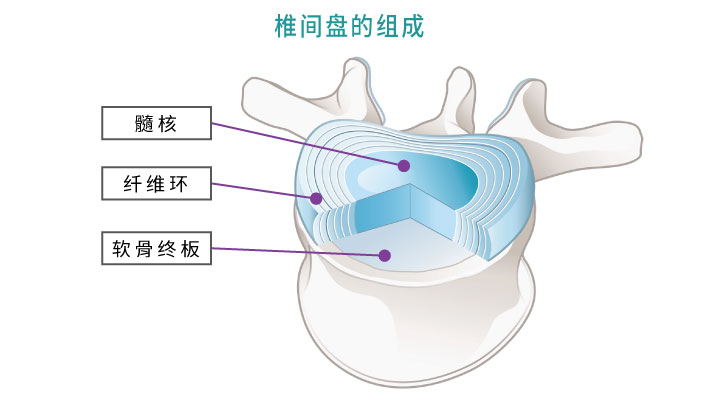 椎间盘病变引起的下背痛