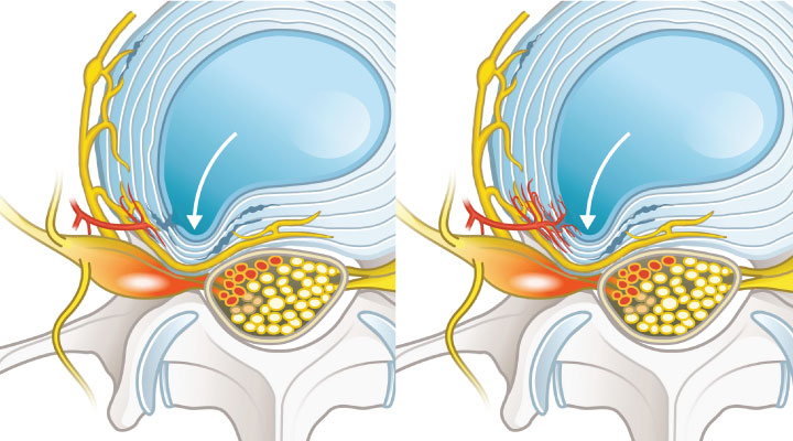 椎間盤病變為何會引起疼痛