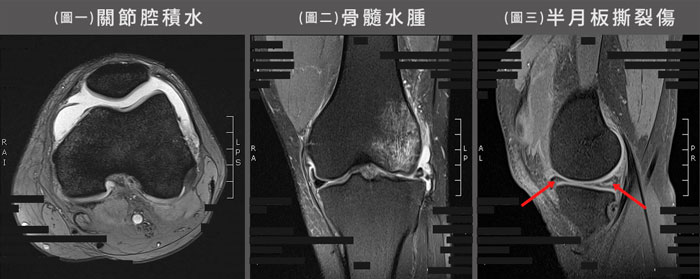 關節腔積水,骨髓水腫,半月板撕裂傷