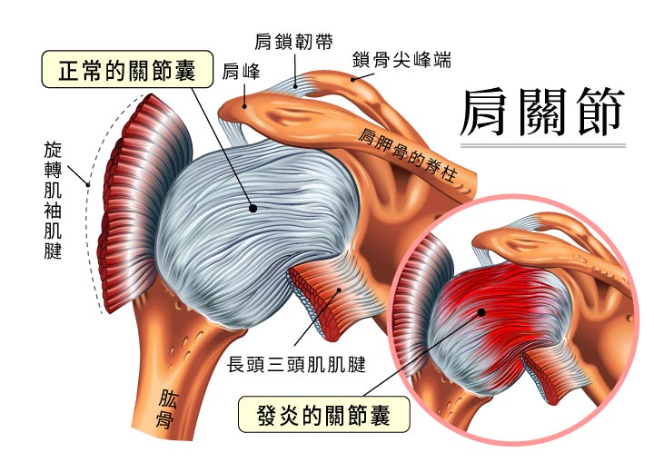 續發性五十肩,主要是肩關節囊及周圍韌帶變厚及攣縮,肌腱受損造成