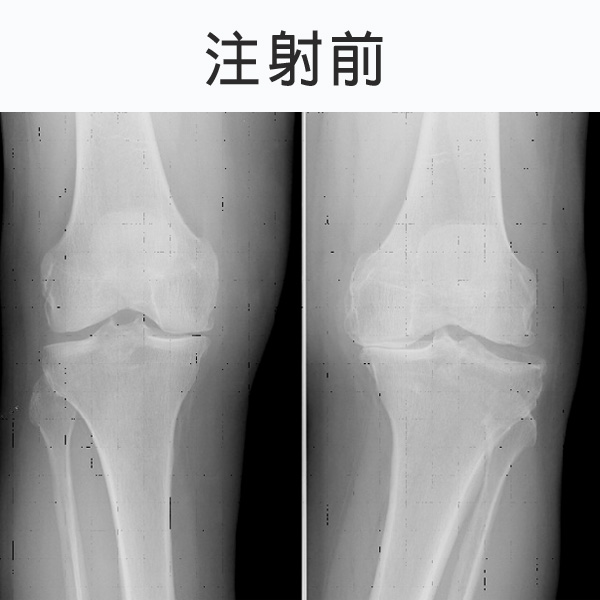 注射治疗前